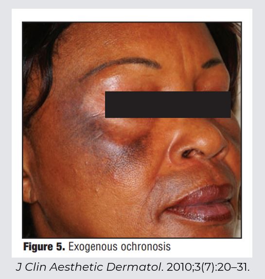 Contoh kasus PIH pada lapisan dermis kulit wajah. 
Sumber: J Clin Aesthetic Dermatol. 2010;3(7):20–31.