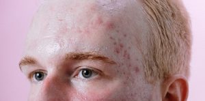 Seorang pria dengan post-inflammatory erythema (PIE) akibat jerawat. Sumber: pexels.com.