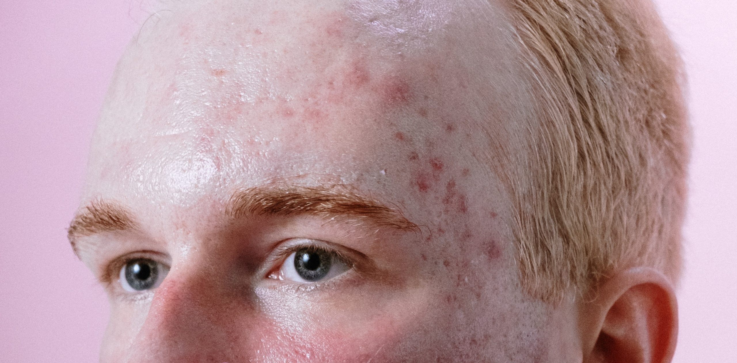 Seorang pria dengan post-inflammatory erythema (PIE) akibat jerawat. Sumber: pexels.com.