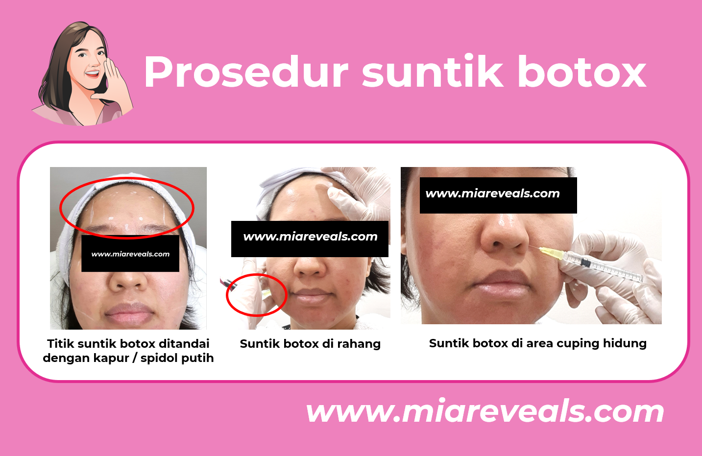 Foto saat prosedur botox wajah di Marvee Clinic, Matraman, Jakarta. Copyright of Miareveals.com.